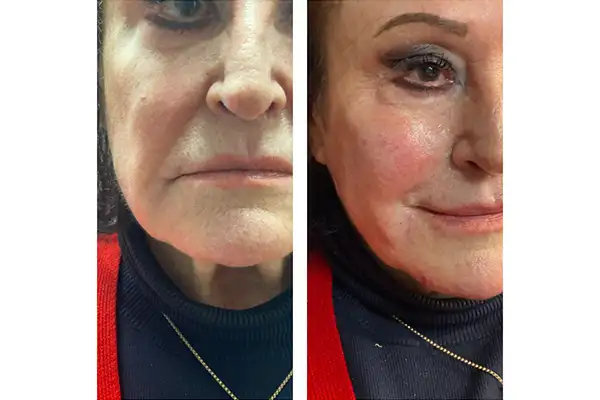 Cheek filler treatment at Elite Beauty Canterbury beauty salon.