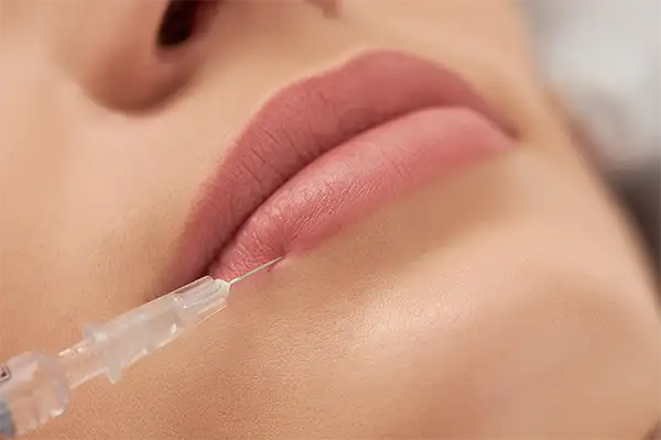 Dermal lip filler treatment at Elite Beauty Canterbury beauty salon.