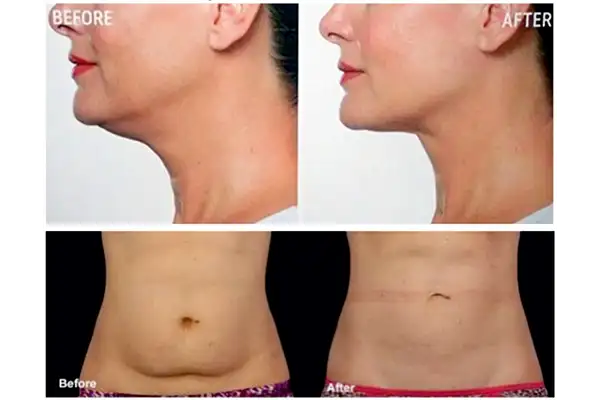 Fat dissolving injection treatment (Aqualyx or Lemon Bottle) at Elite Beauty Canterbury beauty salon.