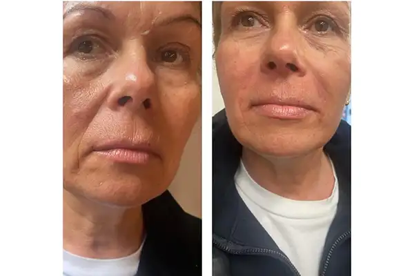 Nasolabial fold filler treatment at Elite Beauty Canterbury beauty salon.