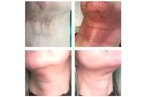 Plasma Pen Fibroblast skin tightening treatment at Elite Beauty Canterbury beauty salon.