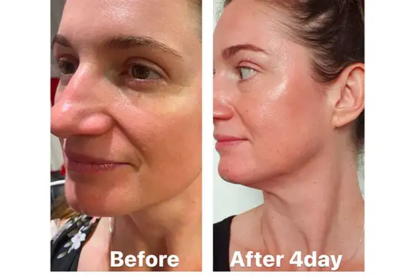 Profhilo skin rejuvenation treatment at Elite Beauty Canterbury beauty salon.