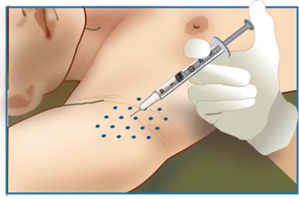Underarm sweating Botox injection treatment at Elite Beauty Canterbury beauty salon.